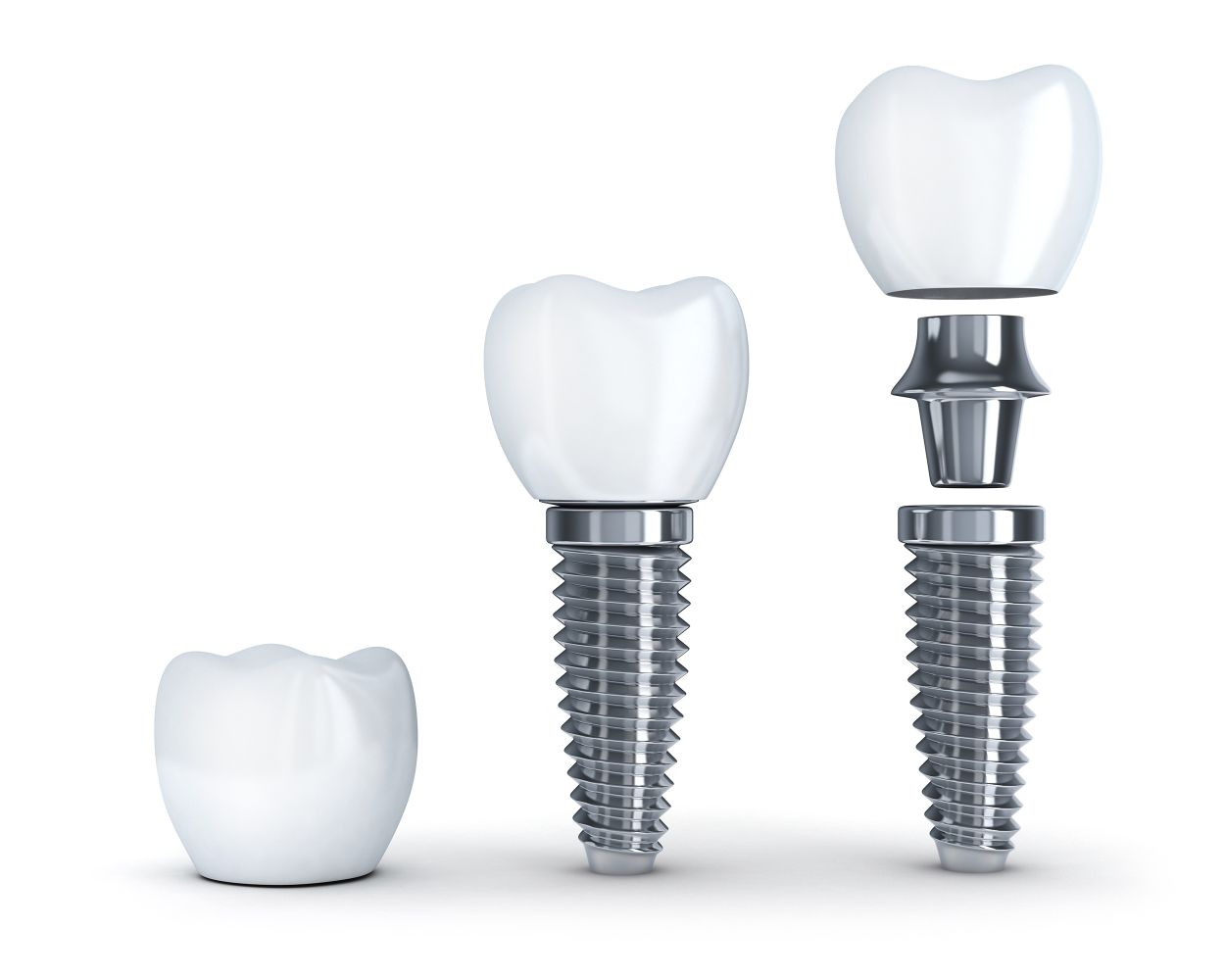 Dental Implants at Ivory Dental
